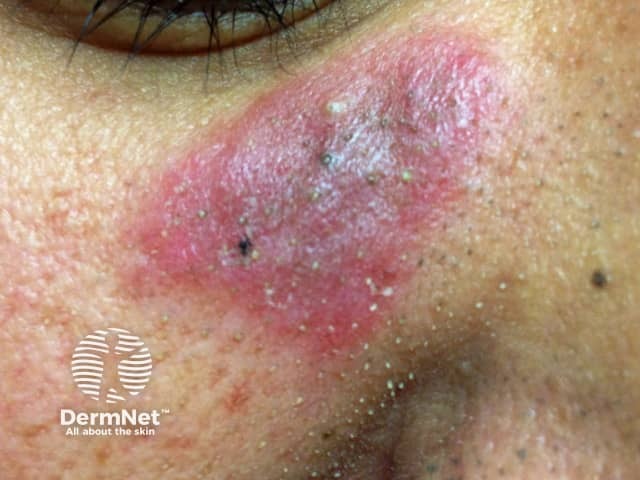 Chronic discoid lupus erythematosus