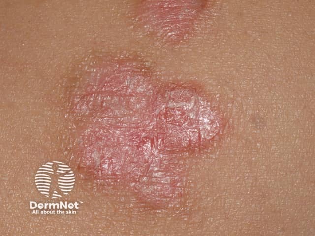 Chronic discoid lupus erythematosus