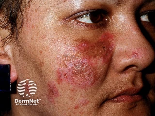 Chronic discoid lupus erythematosus