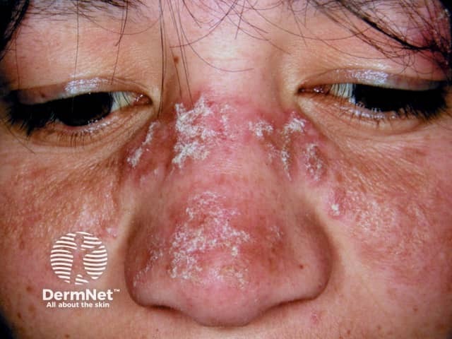 Chronic discoid lupus erythematosus