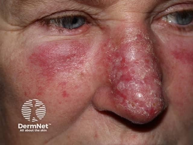 Chronic discoid lupus erythematosus