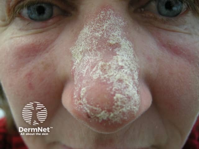 Chronic discoid lupus erythematosus