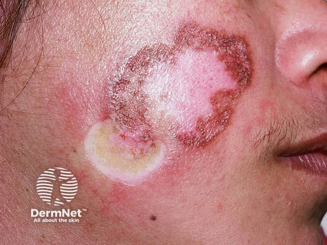 Chronic discoid lupus erythematosus