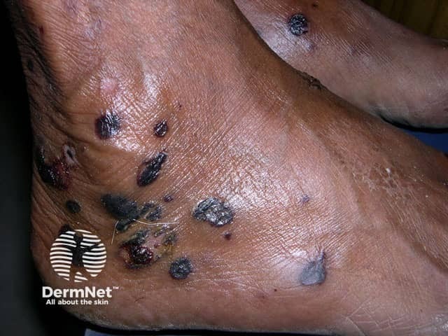 Epidermolysis bullosa acquisita