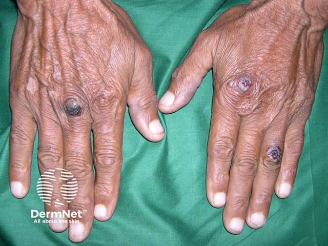 Epidermolysis bullosa acquisita