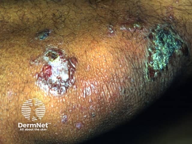 Epidermolysis bullosa acquisita