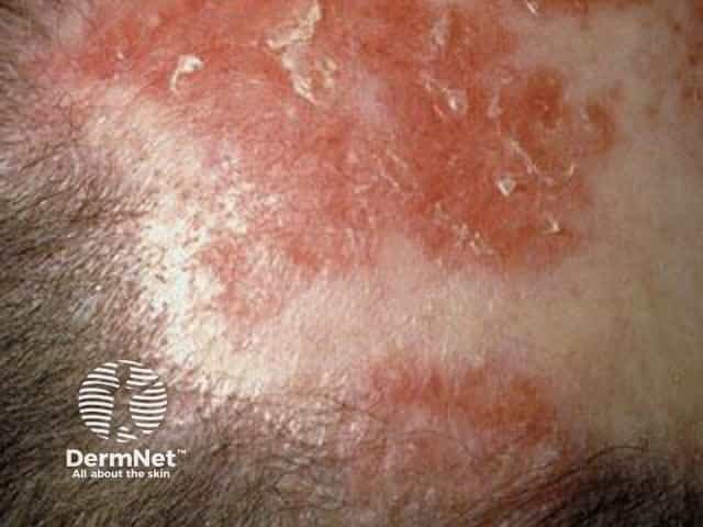 Cutaneous lupus erythematosus