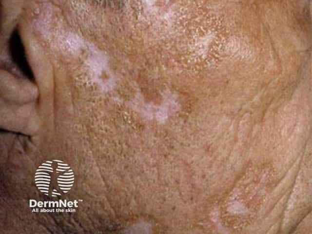 Cutaneous lupus erythematosus