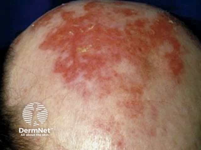 Cutaneous lupus erythematosus