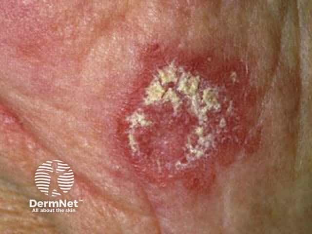 Cutaneous lupus erythematosus