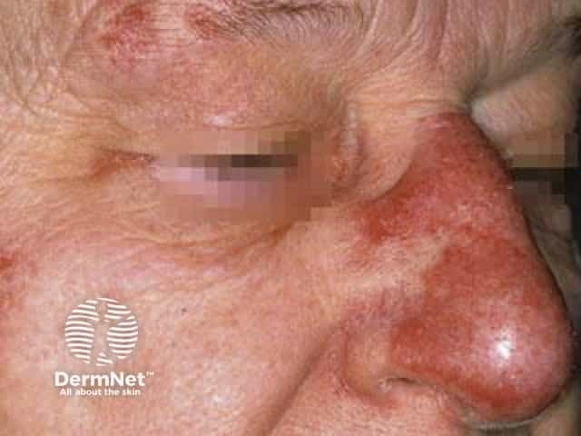 Cutaneous lupus erythematosus