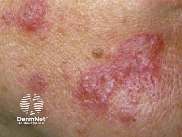 Cutaneous lupus erythematosus