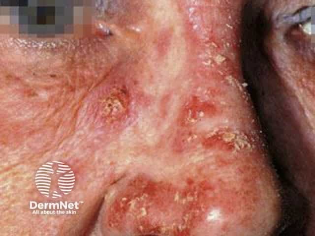 Cutaneous lupus erythematosus