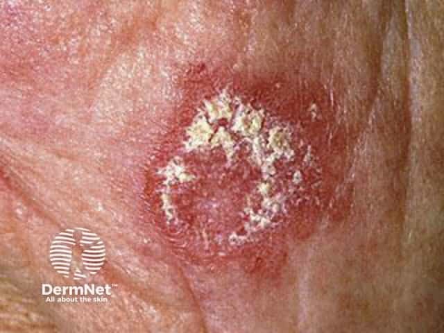 Cutaneous lupus erythematosus