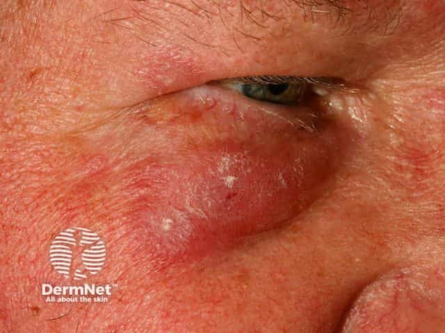 Cutaneous lupus erythematosus