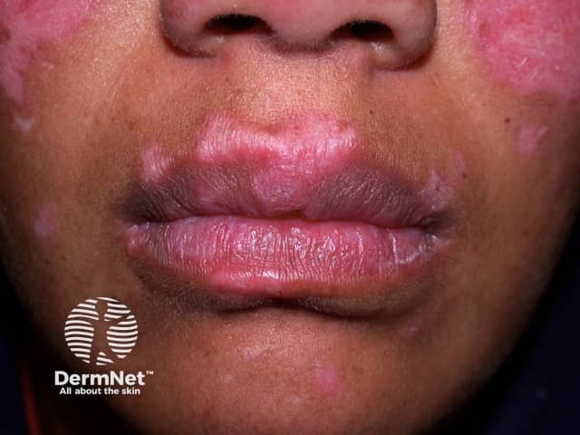 Cutaneous lupus erythematosus