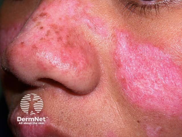 Chronic cutaneous LE