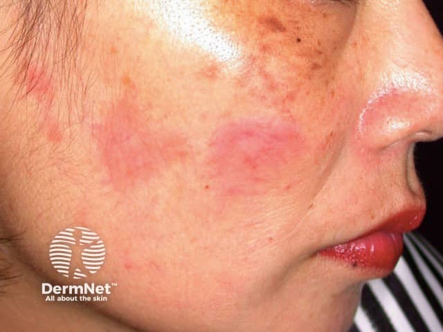 Cutaneous lupus erythematosus