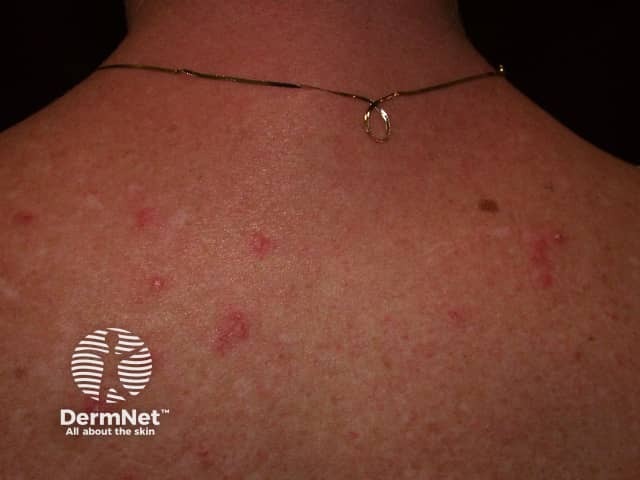 Cutaneous lupus erythematosus