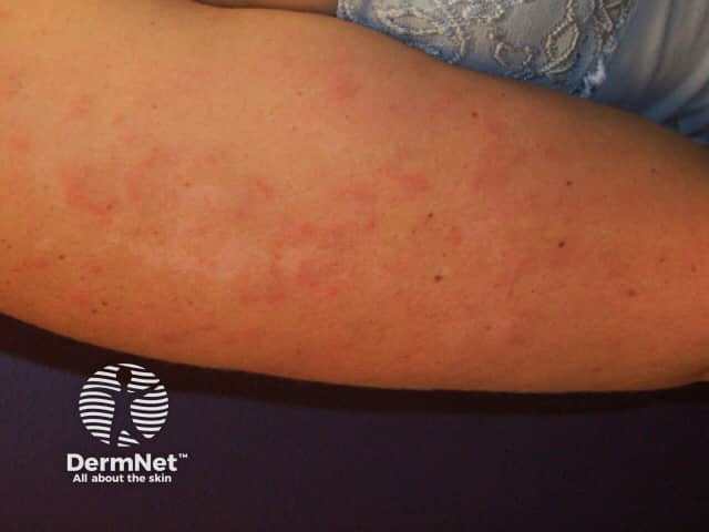 Cutaneous lupus erythematosus