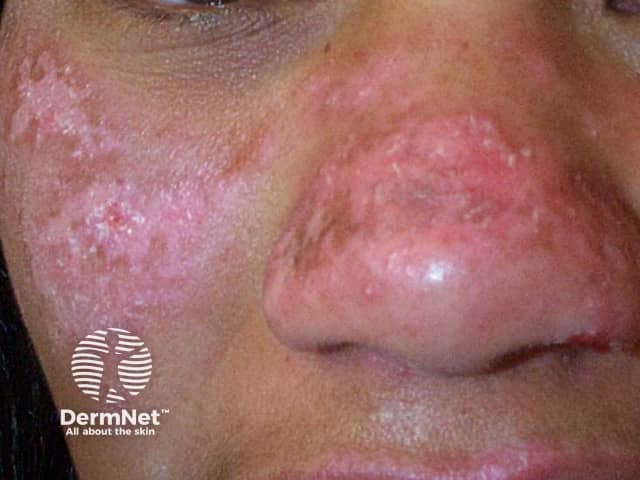 Cutaneous lupus erythematosus