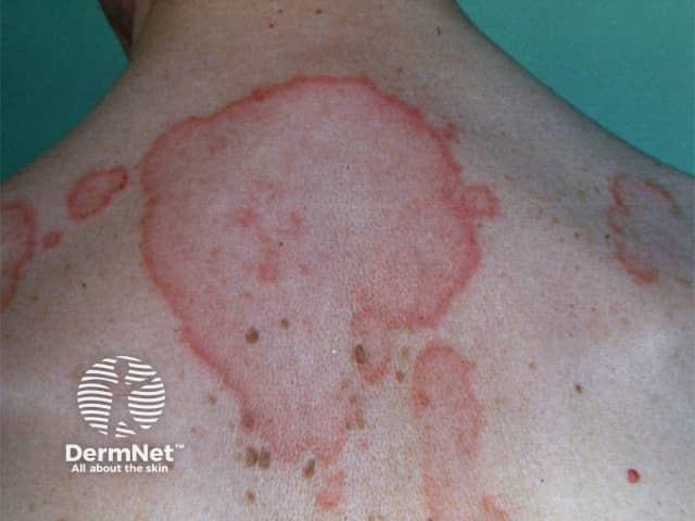 Cutaneous lupus erythematosus