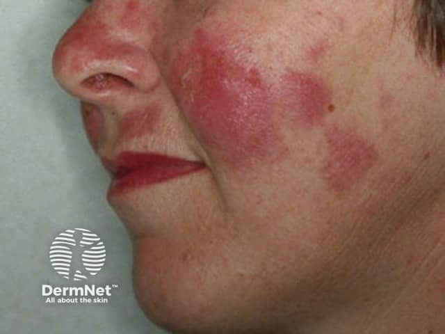 Cutaneous lupus erythematosus