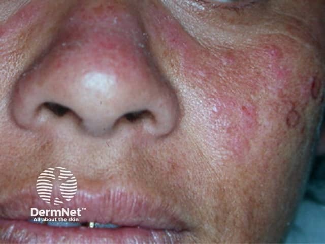 Cutaneous lupus erythematosus