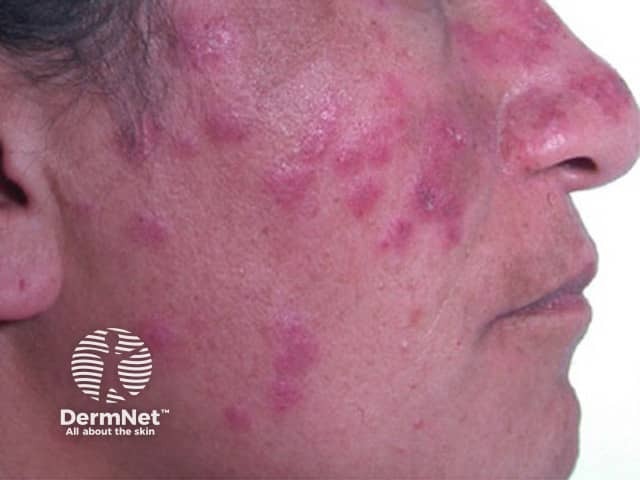 Cutaneous lupus erythematosus