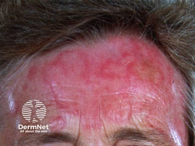 Cutaneous lupus erythematosus