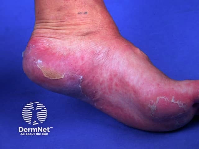 Cutaneous lupus erythematosus