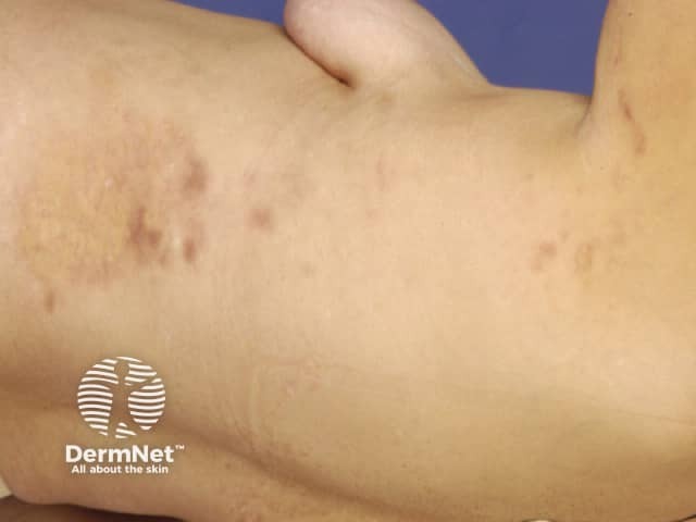 Cutaneous lupus erythematosus