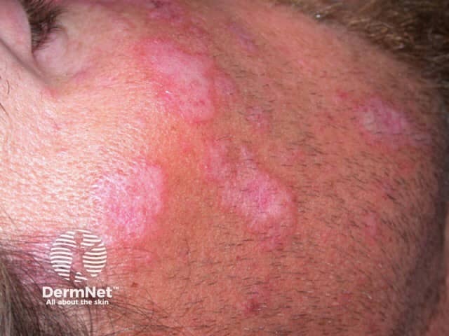 Cutaneous lupus erythematosus