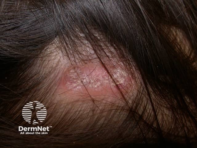 Cutaneous lupus erythematosus