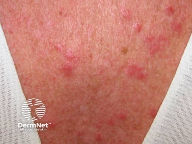 Cutaneous lupus erythematosus