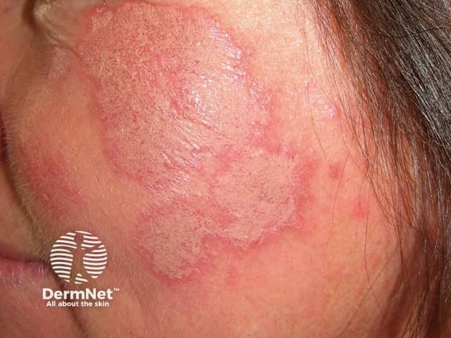 Cutaneous lupus erythematosus