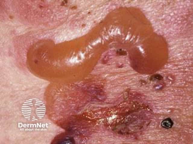 Bullous pemphigoid