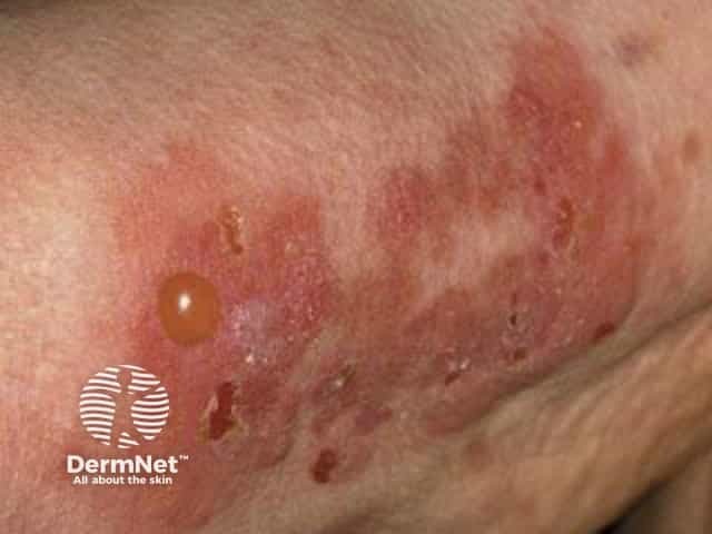 Bullous pemphigoid