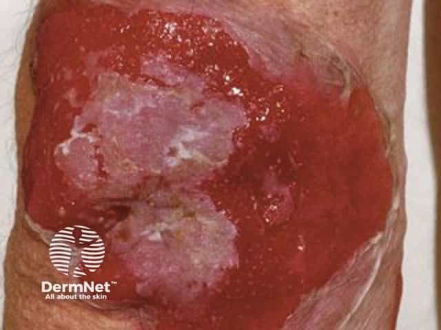 Bullous pemphigoid