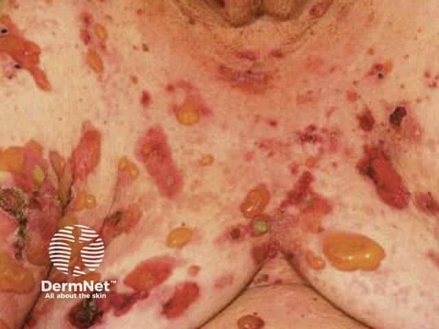 Bullous pemphigoid