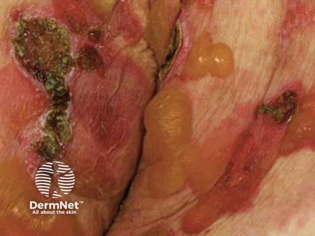 Bullous pemphigoid