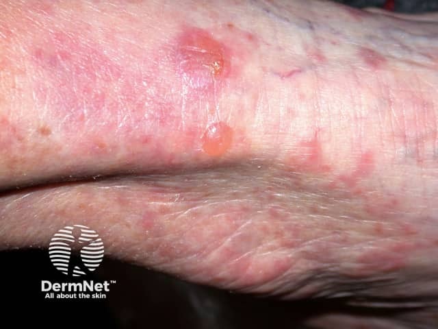 Bullous pemphigoid