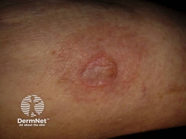 Bullous pemphigoid