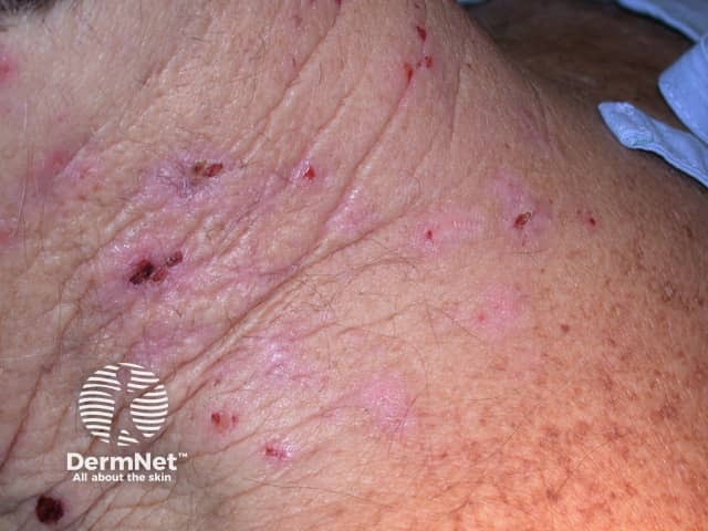 Bullous pemphigoid