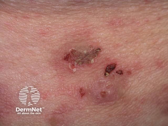 Bullous pemphigoid