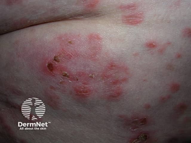 Bullous pemphigoid