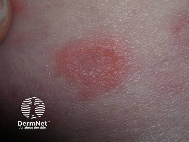 Bullous pemphigoid