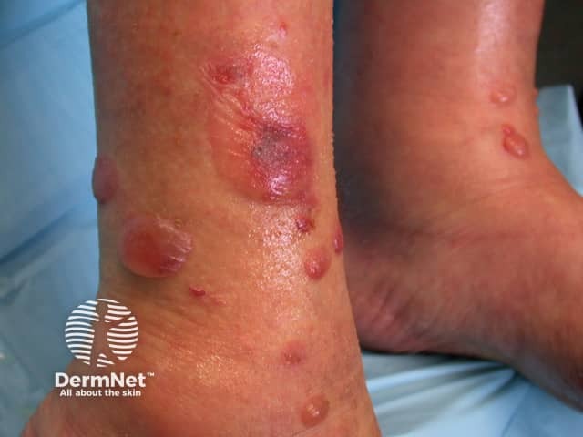 Bullous pemphigoid