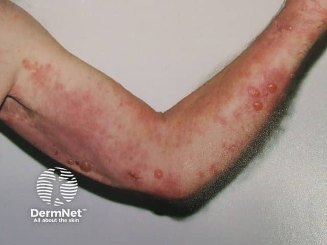 Bullous pemphigoid