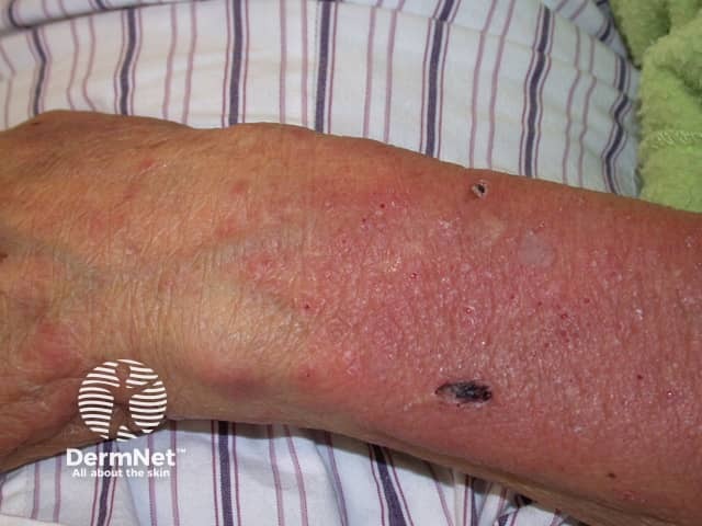 Bullous pemphigoid